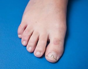 podopraktijk Nagelbeugeltherapie (‘orthonyxie’)